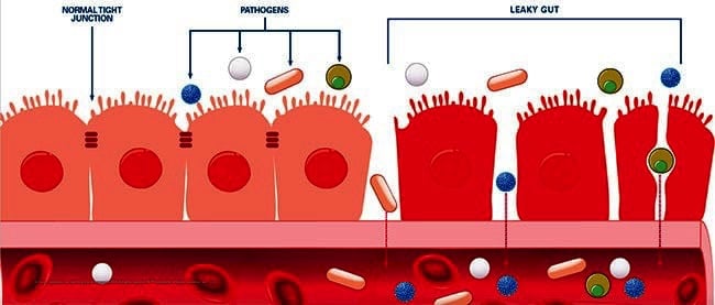 leaky gut syndrome