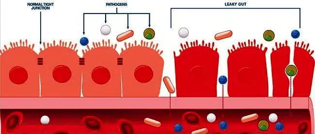 leaky gut syndrome