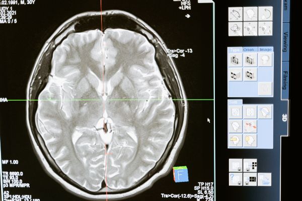 neurotropic factor